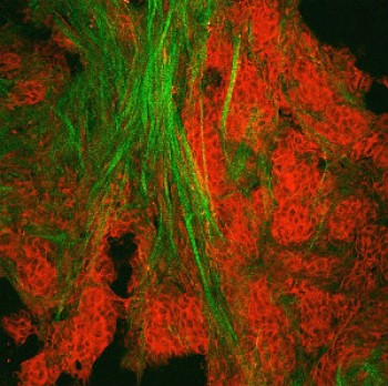 Tissue becomes more stiff as cancer progresses